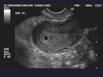 Weeks 4 ultrasound at Early pregnancy